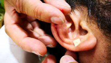 Auriculoterapia