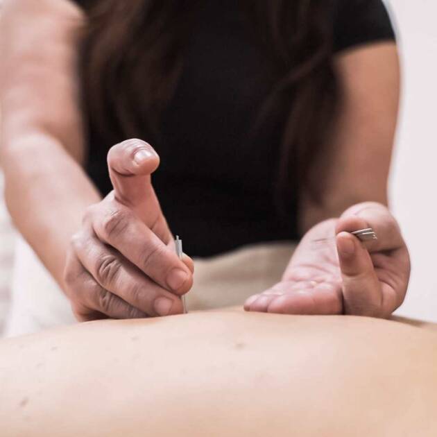 Acupuntura